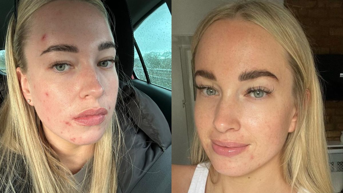 This Skincare Clearing Program Actually Helped Me Get Rid Of My Acne