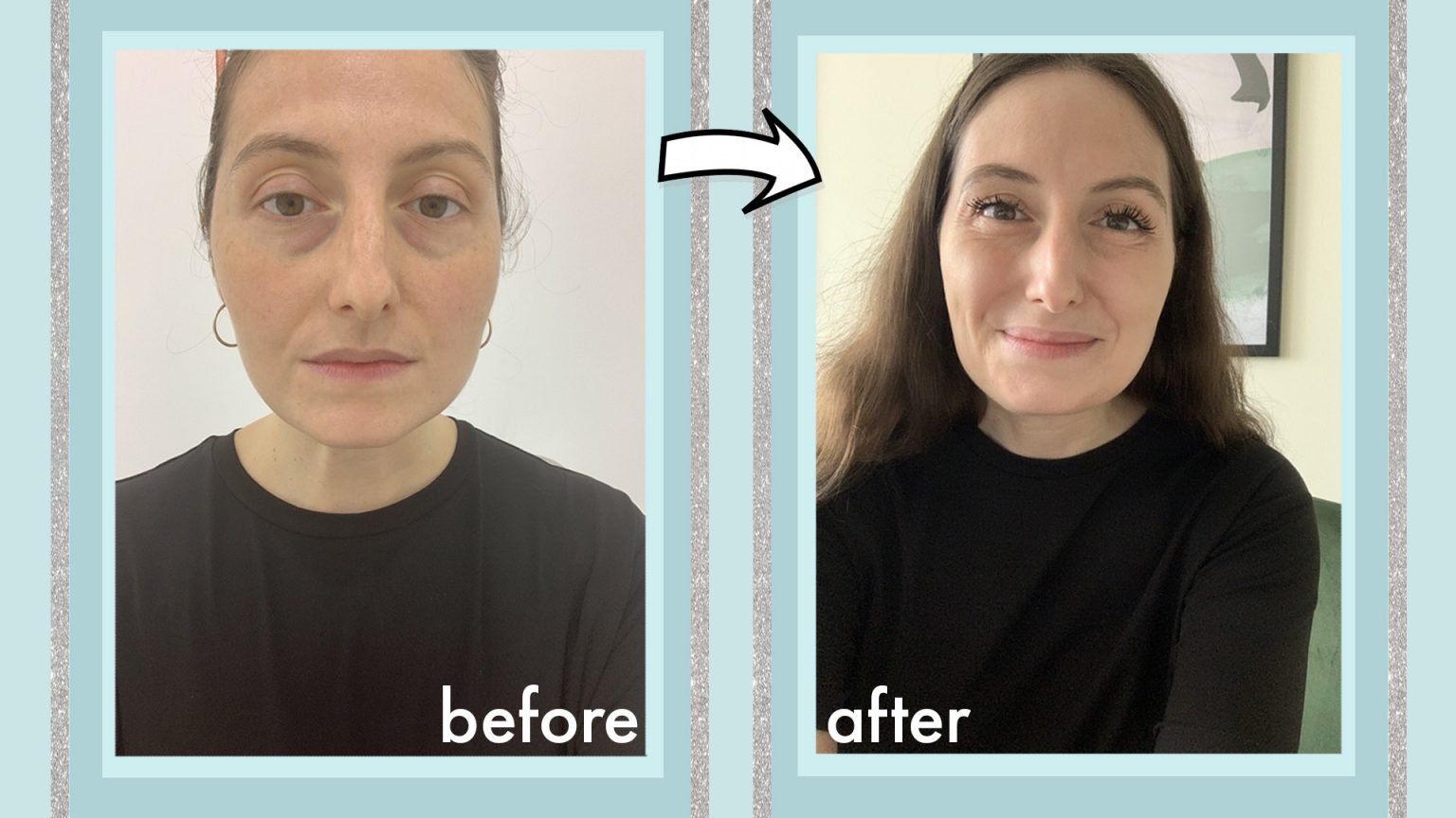 I tried a laser treatment for under-eye bags and the results were ...