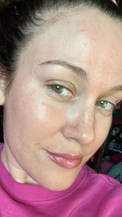 I tried a BBL and Moxi Laser facial, and it did *wonders* for my complexion