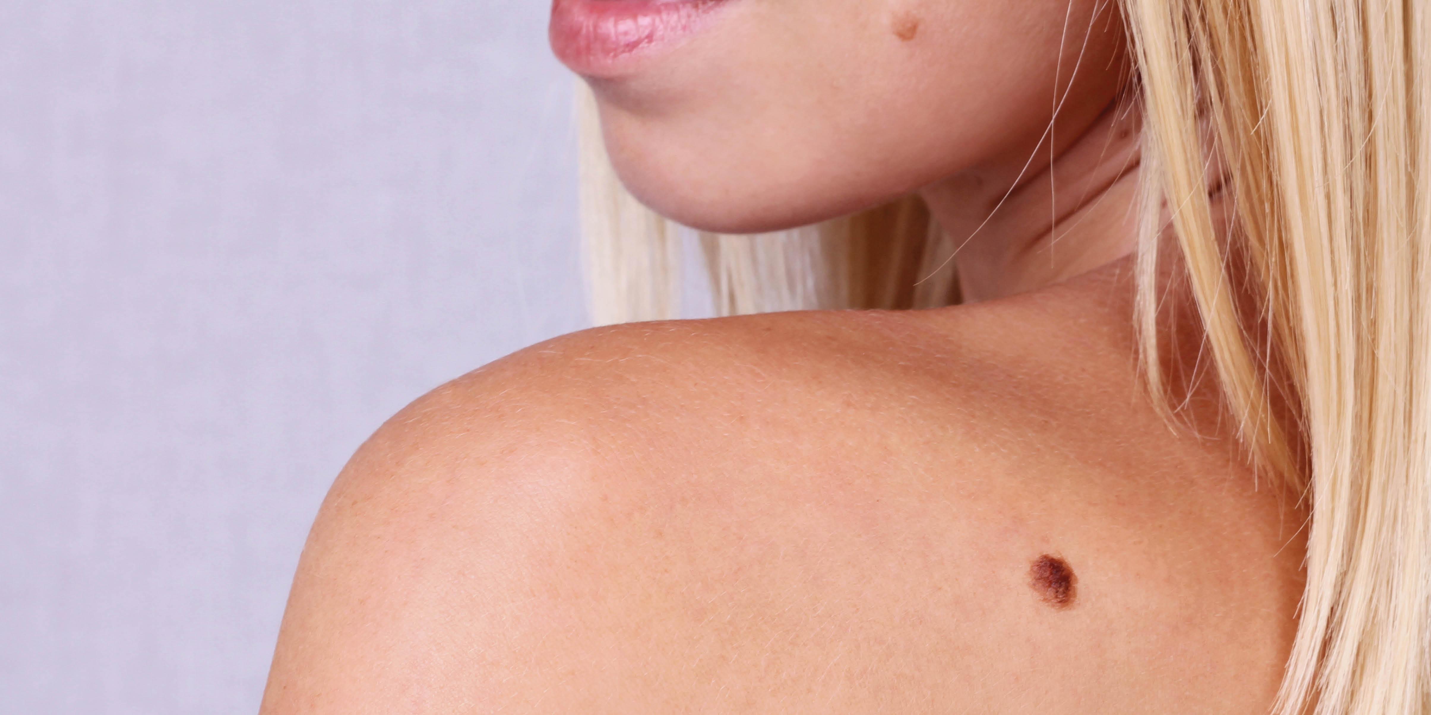 The Panicker S Guide To Moles And Skin Cancer How To Tell If Your Moles Are At Risk Of Becoming Cancerous Body Cosmopolitan Middle East